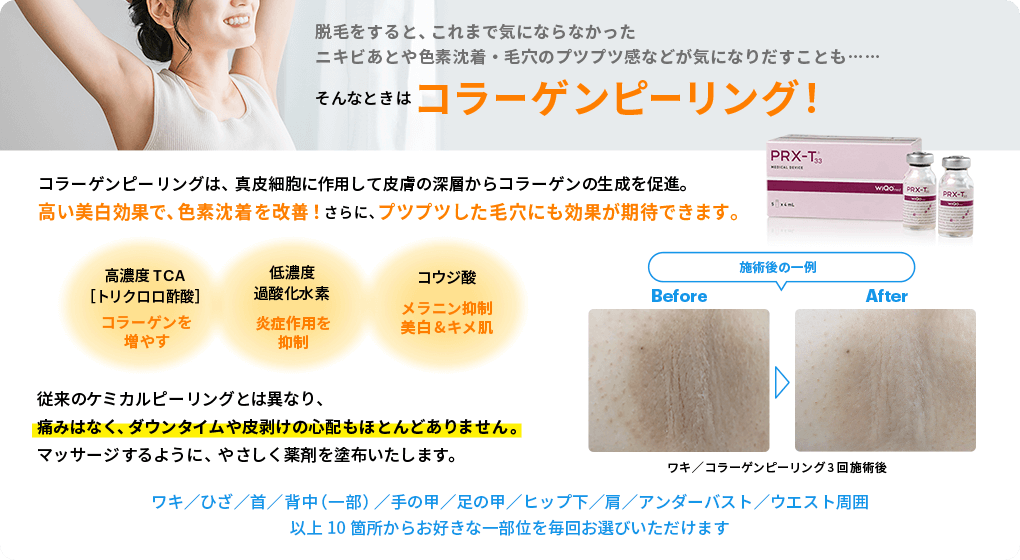 コラーゲンピーリングは、新皮細胞に作用して皮膚の深層からコラーゲンの生成を促進。高い美白効果で、色素沈着を改善！さらに、プツプツした毛穴にも効果が期待できます。