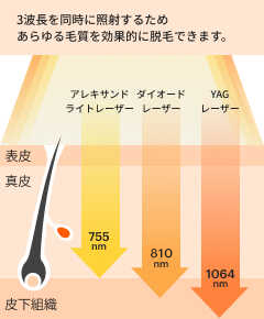 3波長を同時に照射するため、あらゆる毛質を効果的に脱毛できます。