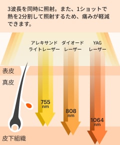 痛みの少ないとされるダイオードレーザーを採用。お肌への負担が少ない機種で毛包だけに無駄なく照射。