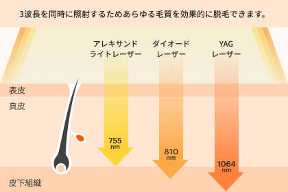 3波長を同時に照射するため、あらゆる毛質を効果的に脱毛できます。