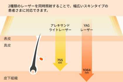 2種類のレーザーを同時照射することで、幅広いスキンタイプの患者様に対応できます。